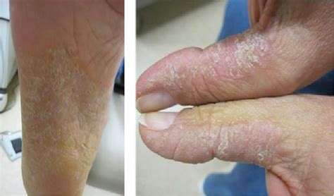 Figure 1 From Successful Treatment Of Palmoplantar Psoriasis Using