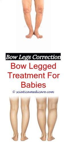 Permanent Remedy For Bow Legs Ideas Bow Legged Bow Legged