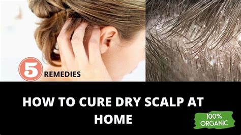 How To Cure Dry Scalp At Home 5 Remedies Youtube