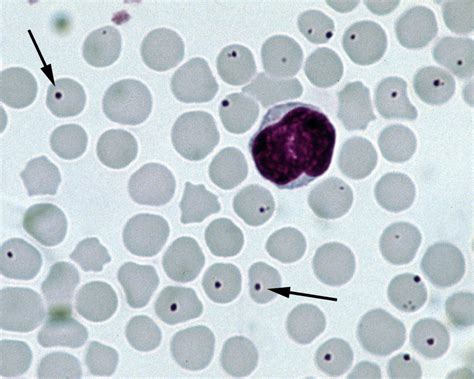 White Blood Cell Inclusions And Abnormalities Hematology