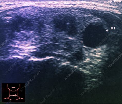 Goitre Ultrasound Scan Stock Image M1650340 Science Photo Library