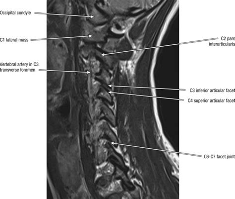 Magnetic Resonance Imaging Of The Cervical Spine Musculoskeletal Key