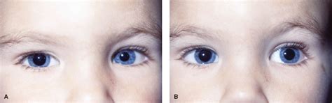 Eye Unequal Pupils Anesthesia Key