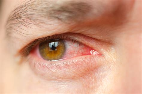 Common Eye Infections Symptoms Eye Vision Infections