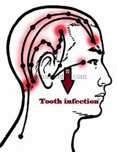 Referred In Head And Neck Region Due To Tooth Infection