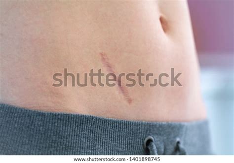 Scar On The Abdomen After Removal Of Appendicitis And Abdominal Surgery
