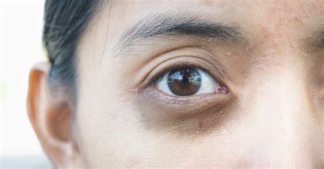 Dark Undereye Circles Causes And Risk Factors Shinagawa Ph