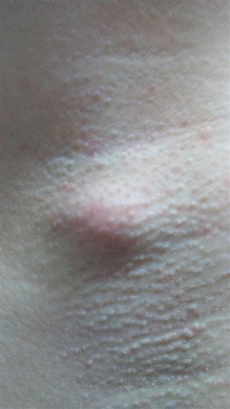 Painful Red Lump On Armpit Basically Showed Up Over Night What Is It
