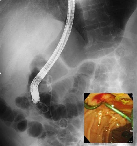 Endoscopic Retrograde Cholangiopancreatography Image Showing The Two