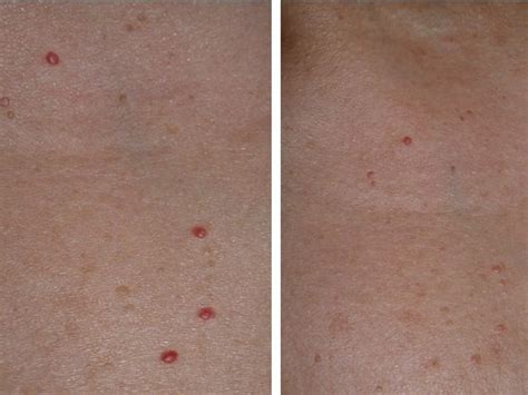 Cherry Angiomas Laser Treatment Lafayette La Renewed Med Spa