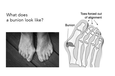 Bunions Hallux Abducto Valgus Dalkey Podiatry Clinic