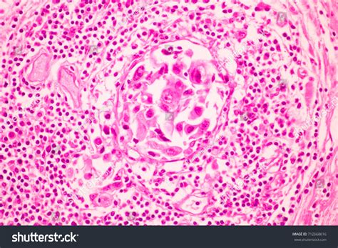 Section Tissue Breast Cancer View Microscopyductal Stock Photo