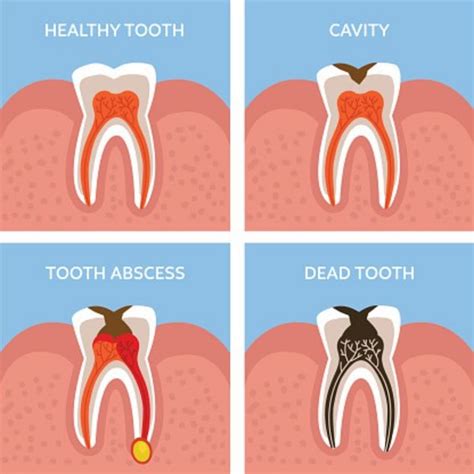 10 years later a dentist told me he wanted to put in a bridge because having a missing tooth would make my other teeth loose, and possibly fall out. Tooth abscess symptoms: What is a dental abscess, how do ...
