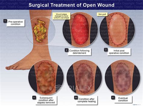 Surgical Treatment Of Open Wound Trial Exhibits Inc