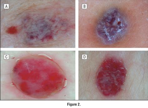 Nodules With A Prominent Vascular Component Dermatology Jama