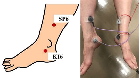 Cureus Efficacy Of Transcutaneous Tibial Nerve Stimulation With