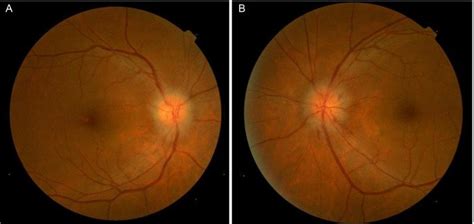 Fundus Photograph Indicating Features Of Optic Disc Edema In Both Eyes