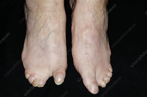 Congenital Webbed Toes Stock Image C004 2451 Science Photo Library