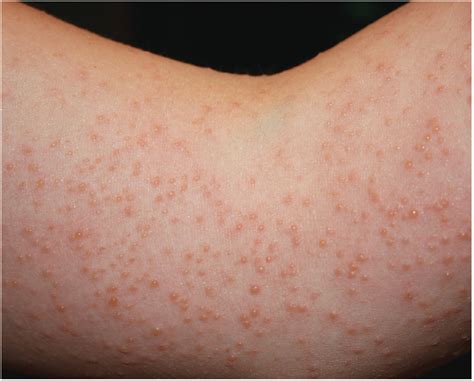 Est Assez Agrandir Aperçu Red Spots On Skin From Sun Exposure Ordinaire