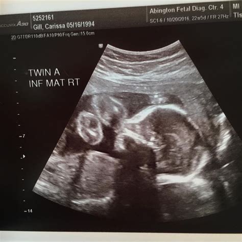 Parents Get A 4d Ultrasound Of Unborn Identical Twin Girls What They