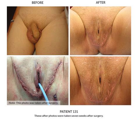 Porn Sex Change Genitalia Sex Pictures Pass