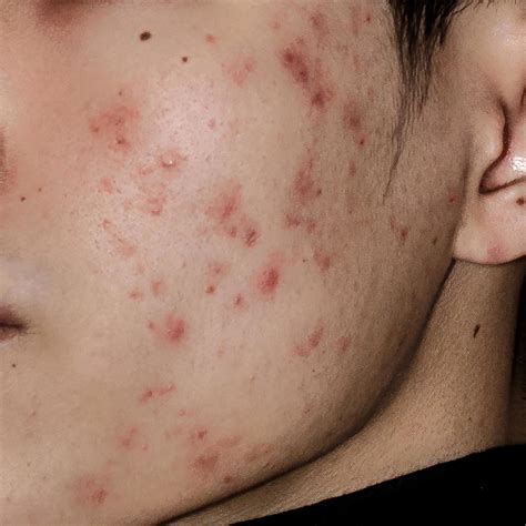 Close Up Of Acne On The Skin Acne On The Face Caused By Hormone