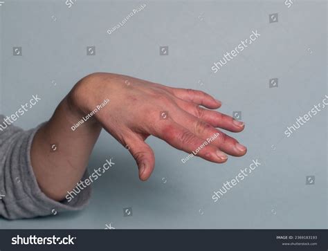Hands Woman Swollen Red Fingers Circulation Stock Photo 2369183193