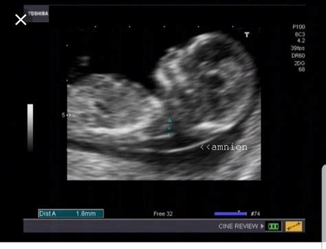 Amnion Ultrasound