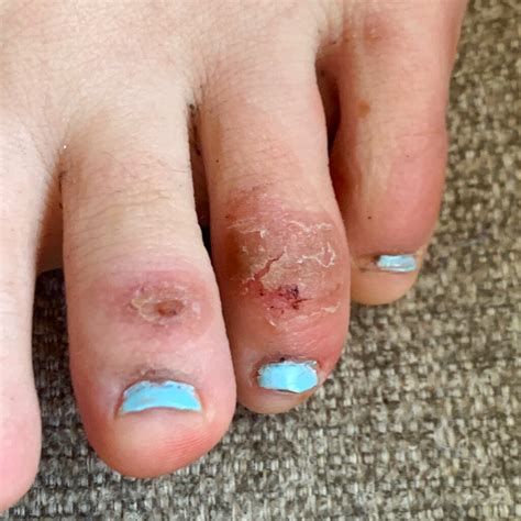 ‘covid Toes Other Rashes Latest Possible Rare Coronavirus Signs