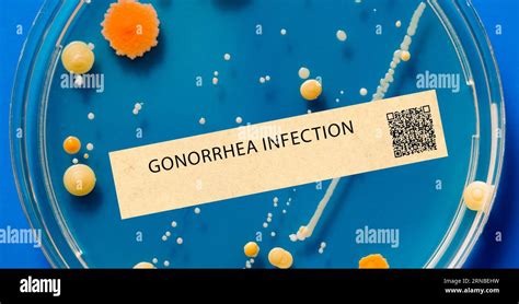 Gonorrhea Sexually Transmitted Bacterial Infection That Can Cause Discharge And Painful