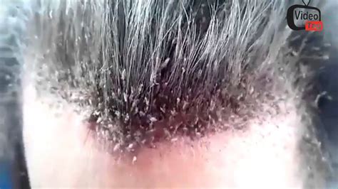 DISGUSTING MASSIVE HAIR LICE INFESTATION - YouTube