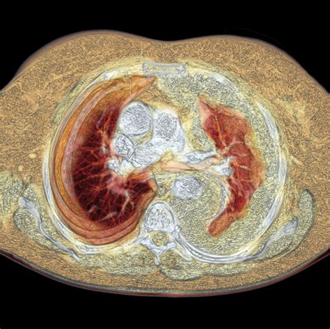 Lung Cancer Ct Scan Photograph By Du Cane Medical Imaging Ltd