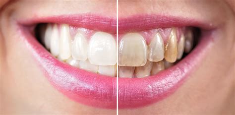 Take Home Teeth Whitening Vs Zoom Center For Restorative And Cosmetic