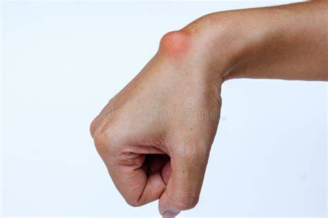 Ganglion Cyst On Finger Stock Photo Image Of Cyst Healthcare 108414020