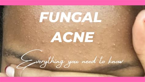 This is quite different to regular bacterial acne, where you see blocked pores. HOW TO GET RID OF FUNGAL ACNE - Sharon Malonza