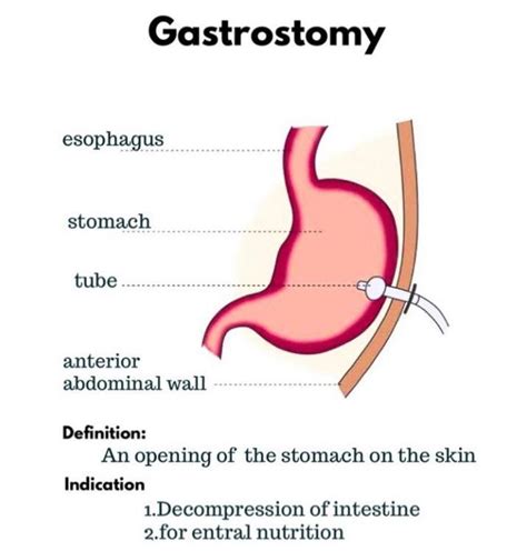 What Is Gastrostomy Medizzy