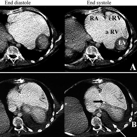 Type C With Massive Tricuspid Valve Insufficiency Patient 19 Is A