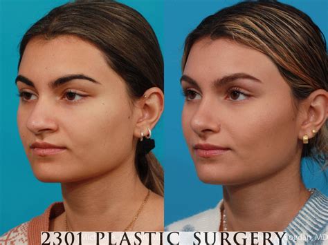 Rhinoplasty Before And After Pictures Case 684 Fort Worth Plano