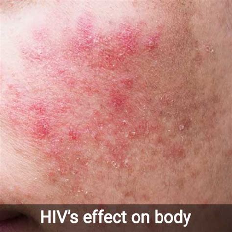 Can Hiv Cause White Spots On Lips