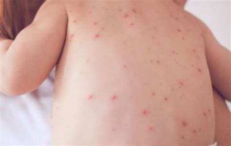 10 Signs And Symptoms Of Measles You Need To Know
