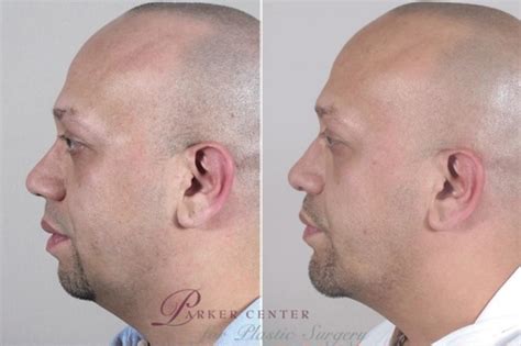 Chin Implant Before And After Pictures Case 953 Paramus Nj Parker