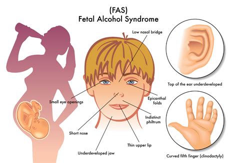 Fetal Alcohol Syndrome In Adults