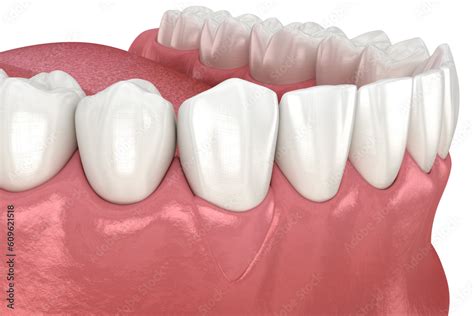 Gingiva Recession Soft Tissue Graft Surgery 3d Illustration Of Dental