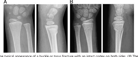 Greenstick Fracture Distal Radius Moryte