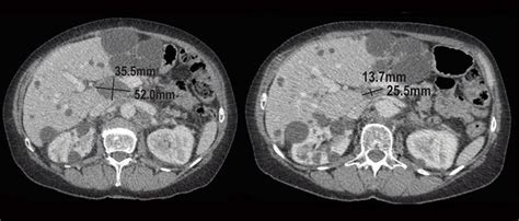 Can A Ct Scan Detect Ovarian Cancer