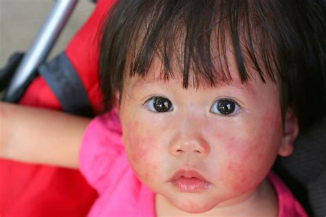 Symptoms Of Fifth Disease In Children And Adults Health And Detox