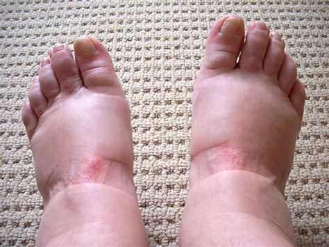 Peripheral Edema Or Swelling In Ankles And Feet Dr Thind