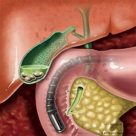 Endoscopic Gallbladder Stenting Procedure