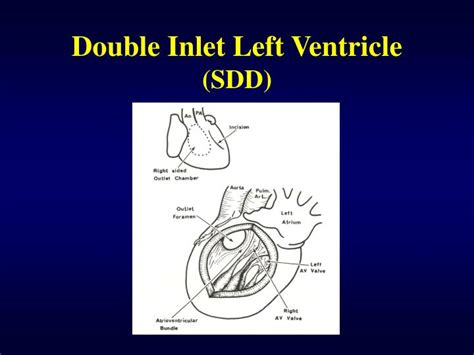 Ppt Double Inlet Ventricle Powerpoint Presentation Id282508