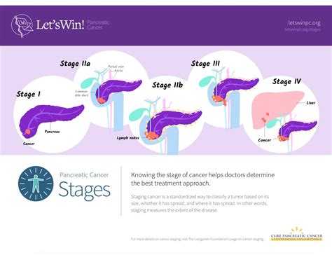Symptoms Of Stage 4 Pancreatic Cancer